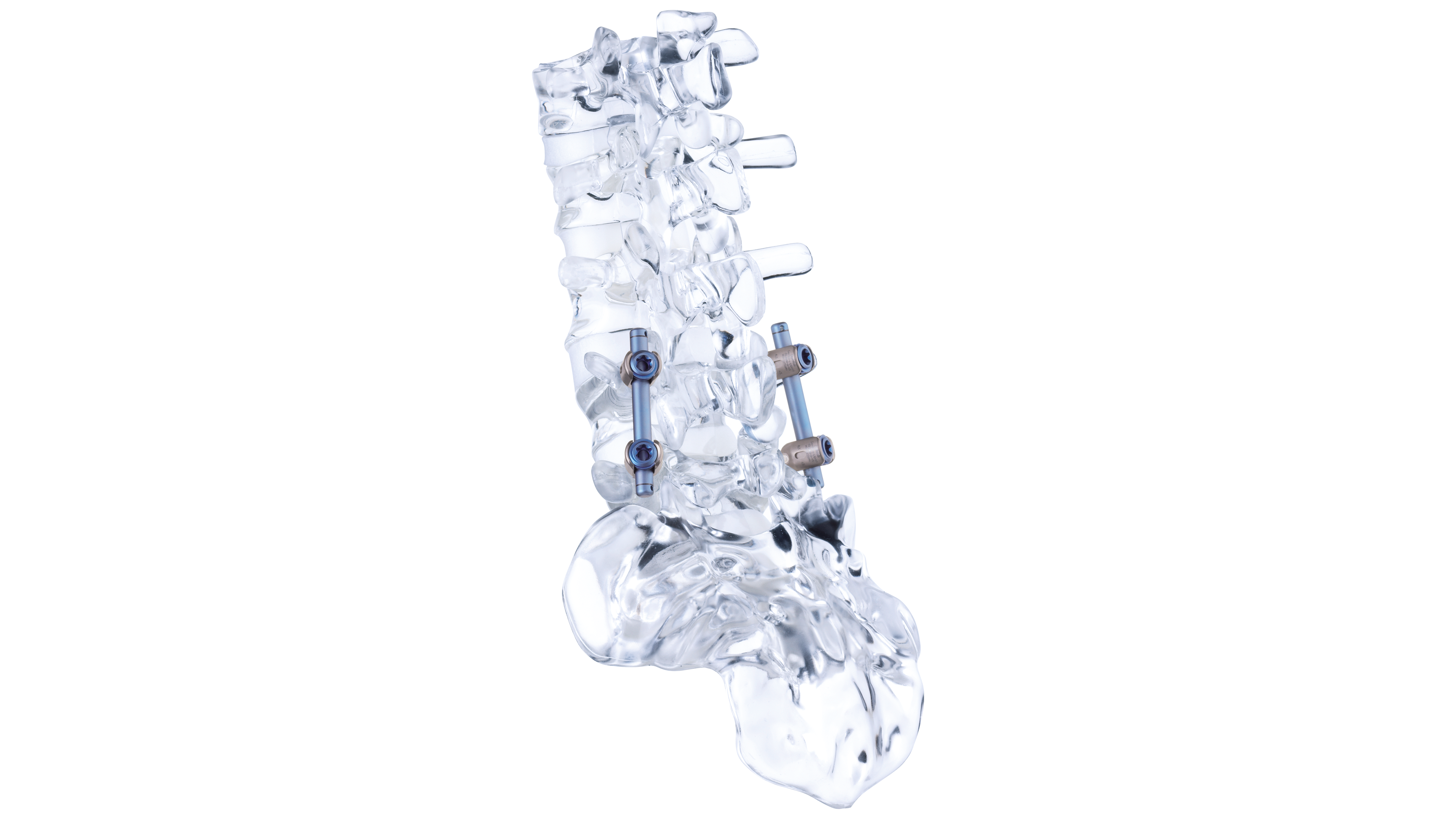 Vista lateral de un modelo de cristal de una estabilización dinámica de la columna vertebral con el sistema de varilla-tornillo cosmicMIA de ulrich medical.
