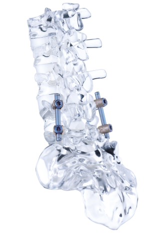 Seitliche Ansicht eines Glasmodells einer dynamischen Stabilisierung der Wirbelsäule mit dem Stab-Schrauben-System cosmicMIA von ulrich medical