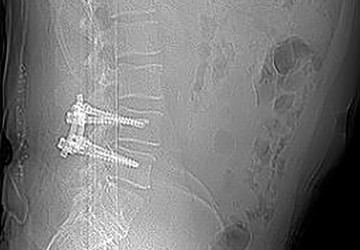 Röntgentbild einer dynamischen Stabilisierung bei zystenbedingter Spinalkanalstenose und Spondylolisthese mit cosmicMIA