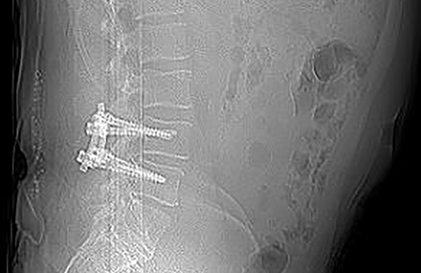 X-ray image of dynamic stabilization for cyst-related spinal canal stenosis and spondylolisthesis with cosmicMIA | © ulrich medical. All rights reserved. Use, reproduction or transfer without express authorization is not permitted.