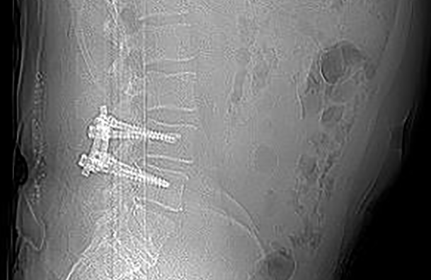 Radiographie d'une stabilisation dynamique en cas de sténose du canal rachidien due à un kyste et de spondylolisthésis avec cosmicMIA