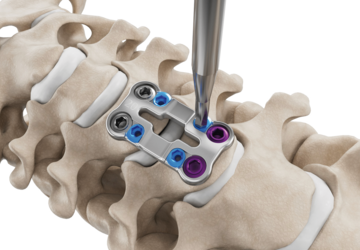Darstellung der Sicherung des Verriegelungsmechanismus des zervikalen Plattensystems Artus von ulrich medical. | © 2025 ulrich medical. Alle Rechte vorbehalten. Die Verwendung, Vervielfältigung oder Weitergabe ohne ausdrückliche Genehmigung ist nicht gestattet.
