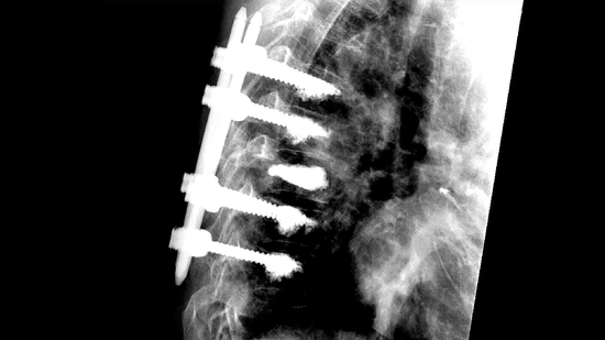 © Ulrich Medical. Todos los derechos reservados. Queda prohibido el uso, la reproducción o la distribución sin autorización expresa.