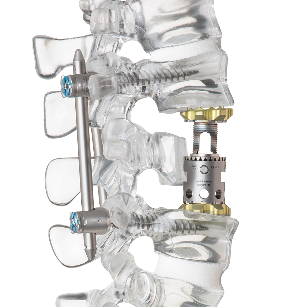 Corpectomy: Procedure, indications, and solutions