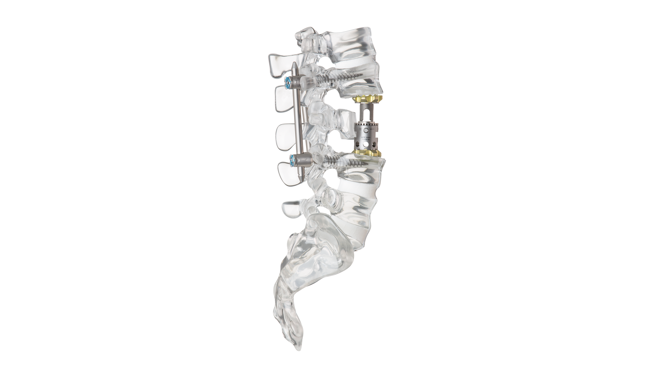 obelisc™ – Expandable vertebral body replacement