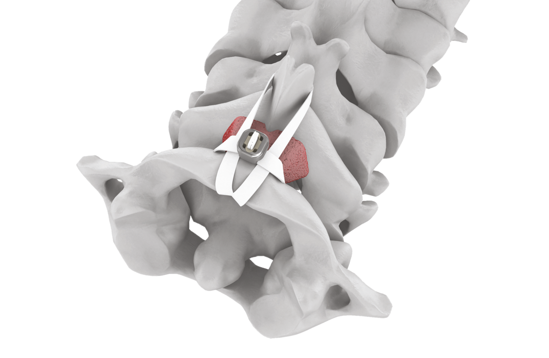 © 2025 ulrich medical. Alle Rechte vorbehalten. Die Verwendung, Vervielfältigung oder Weitergabe ohne ausdrückliche Genehmigung ist nicht gestattet.