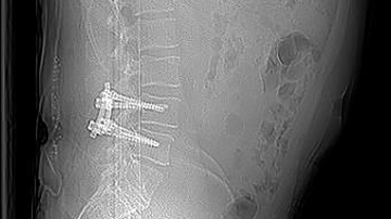 X-ray image of dynamic stabilization for cyst-related spinal canal stenosis and spondylolisthesis with cosmicMIA | © ulrich medical. All rights reserved. Use, reproduction or transfer without express authorization is not permitted.