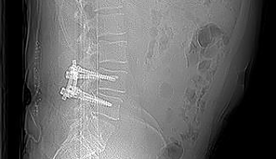 Röntgentbild einer dynamischen Stabilisierung bei zystenbedingter Spinalkanalstenose und Spondylolisthese mit cosmicMIA | © 2025 ulrich medical. Alle Rechte vorbehalten. Die Verwendung, Vervielfältigung oder Weitergabe ohne ausdrückliche Genehmigung ist nicht gestattet.
