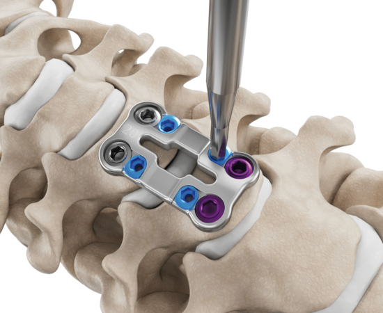 Illustration of how to secure the locking mechanism of the cervical plate system Artus by ulrich medical. | © ulrich medical. All rights reserved. Use, reproduction or transfer without express authorization is not permitted.
