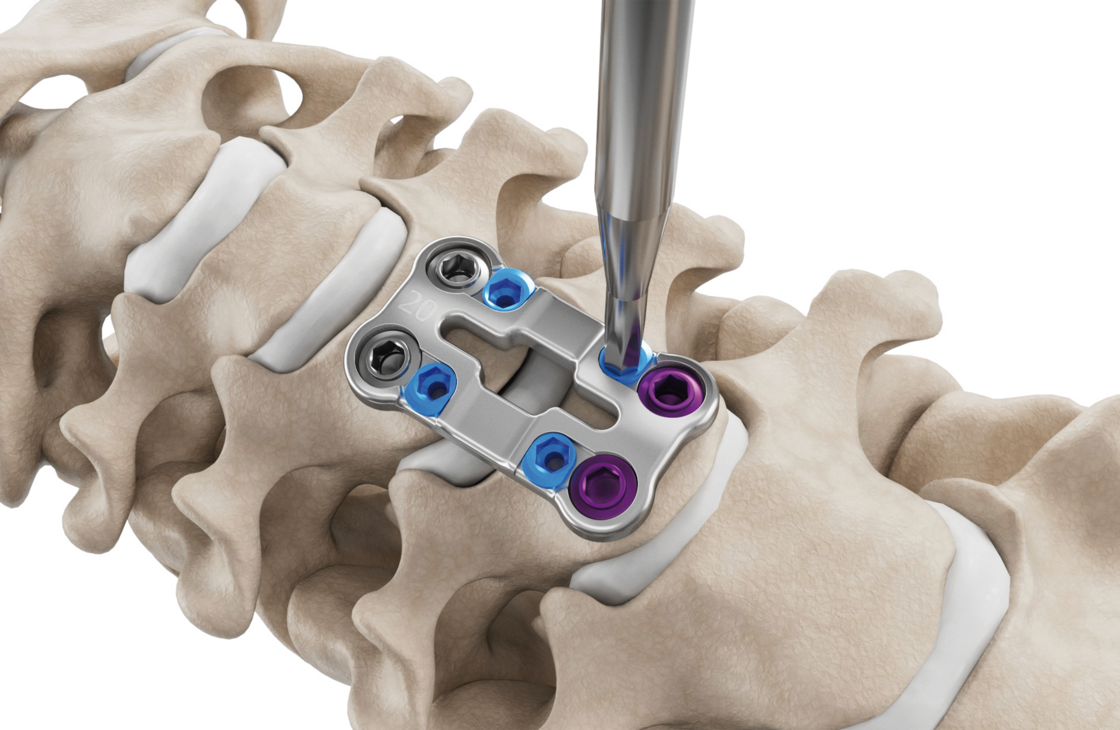 Ilustración de la fijación del mecanismo de bloqueo del sistema de placa cervical Artus de ulrich medical. | © Ulrich Medical. Todos los derechos reservados. Queda prohibido el uso, la reproducción o la distribución sin autorización expresa.