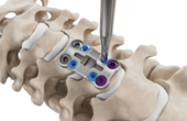 Ilustración de la fijación del mecanismo de bloqueo del sistema de placa cervical Artus de ulrich medical. | © Ulrich Medical. Todos los derechos reservados. Queda prohibido el uso, la reproducción o la distribución sin autorización expresa.