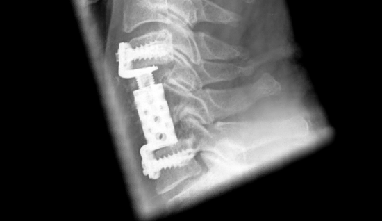 Röntgenbild einer Korpektomie von Halswirbelkörper 5 und 6 , Dekompression und Wirbelkörperersatz mit ADDplus von ulrich medical. | © 2025 ulrich medical. Alle Rechte vorbehalten. Die Verwendung, Vervielfältigung oder Weitergabe ohne ausdrückliche Genehmigung ist nicht gestattet.