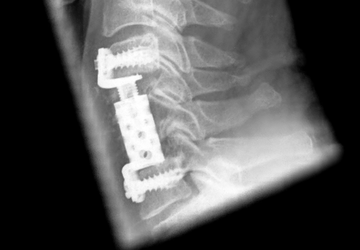Röntgenbild einer Korpektomie von Halswirbelkörper 5 und 6 , Dekompression und Wirbelkörperersatz mit ADDplus von ulrich medical. | © 2025 ulrich medical. Alle Rechte vorbehalten. Die Verwendung, Vervielfältigung oder Weitergabe ohne ausdrückliche Genehmigung ist nicht gestattet.