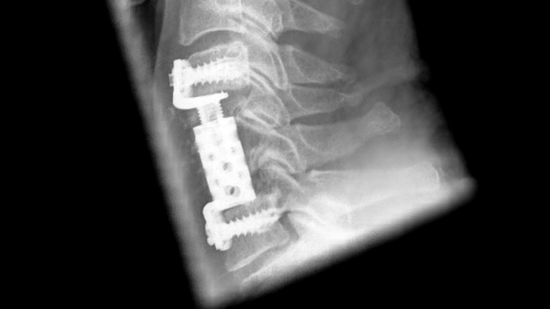 Röntgenbild einer Korpektomie von Halswirbelkörper 5 und 6 , Dekompression und Wirbelkörperersatz mit ADDplus von ulrich medical. | © 2025 ulrich medical. Alle Rechte vorbehalten. Die Verwendung, Vervielfältigung oder Weitergabe ohne ausdrückliche Genehmigung ist nicht gestattet.
