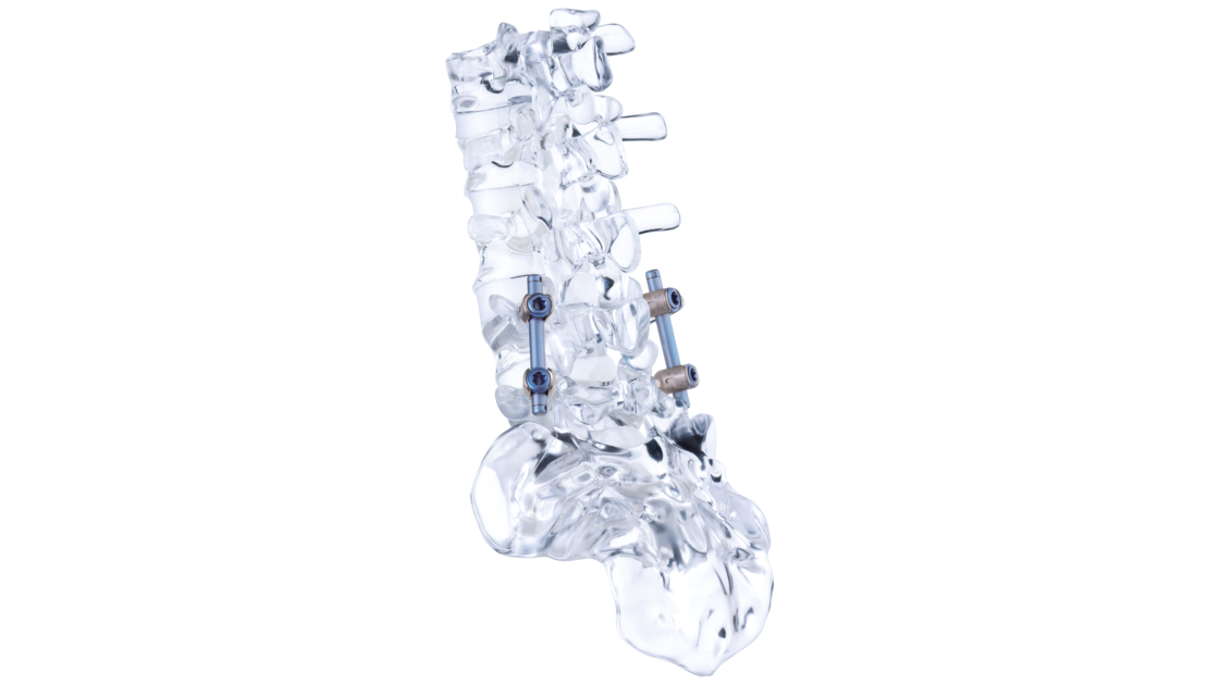 Vista lateral de un modelo de cristal de una estabilización dinámica de la columna vertebral con el sistema de varilla-tornillo cosmicMIA de ulrich medical. | © Ulrich Medical. Todos los derechos reservados. Queda prohibido el uso, la reproducción o la distribución sin autorización expresa.