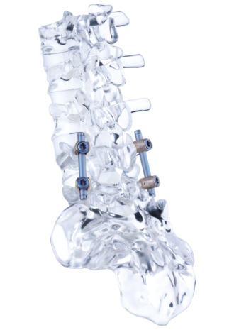 Lateral view of a glass model of a dynamic stabilization of the spine with the cosmicMIA screw-rod system from ulrich medical | © ulrich medical. All rights reserved. Use, reproduction or transfer without express authorization is not permitted.